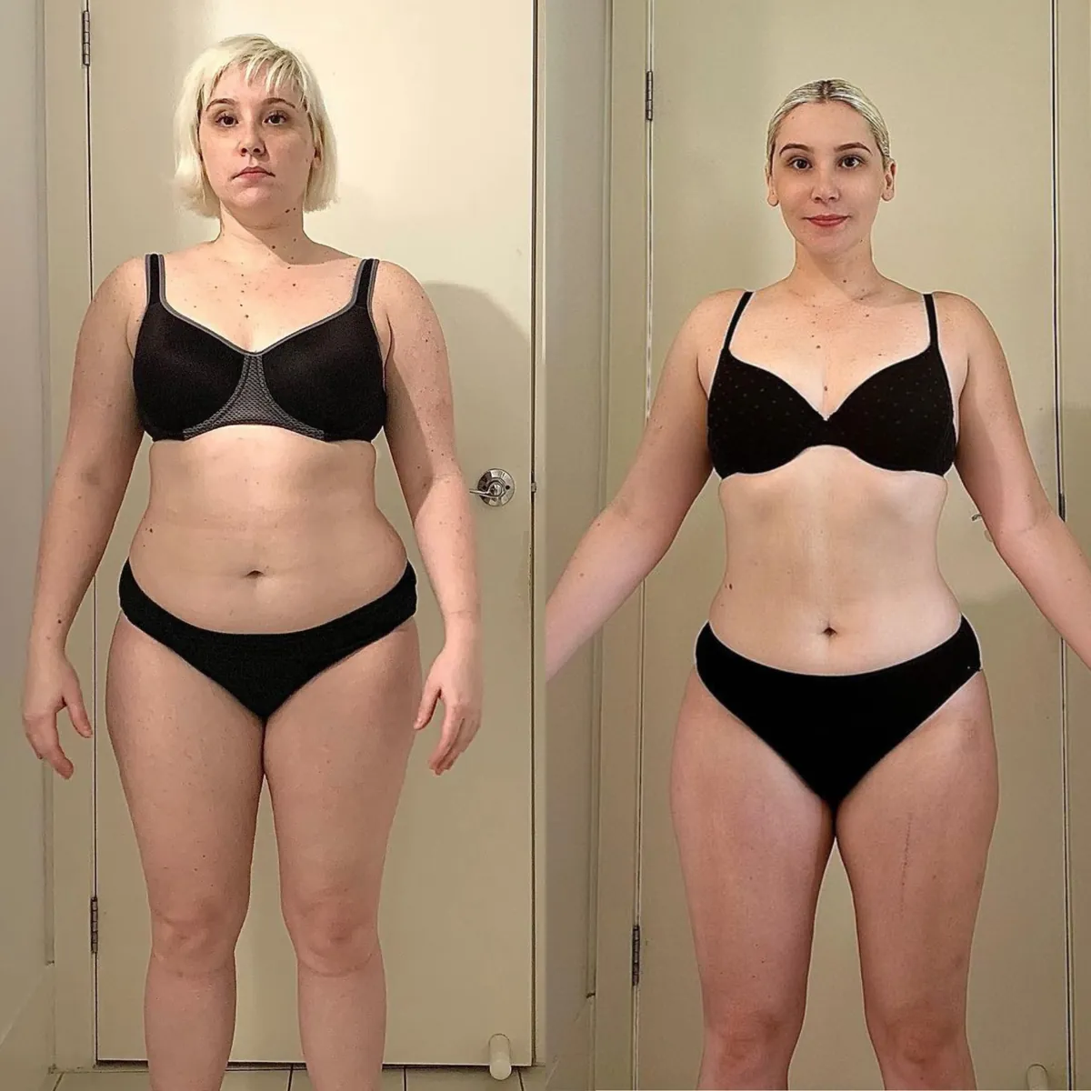 Emily before and after, front on. The after photo shows a leaner waist and more defined shape.